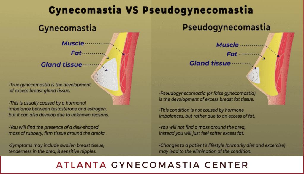 Gynecomastia vs. Pseudogynecomastia Atlanta