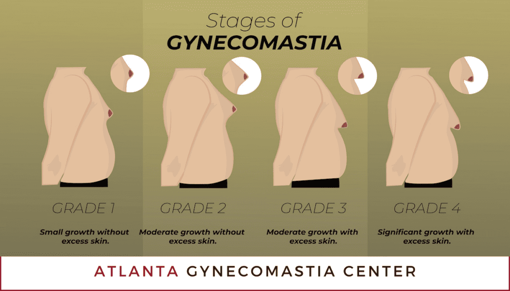 Stages and Grades of Gynecomastia Atlanta