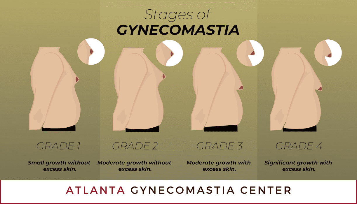 Stages and Grades of Gynecomastia Atlanta
