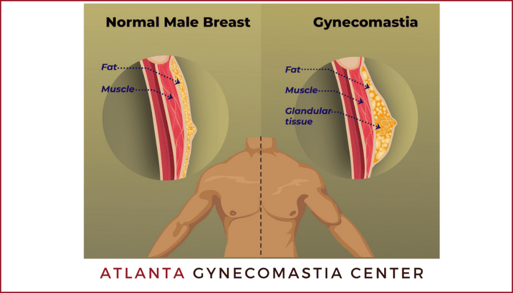 What is Gynecomastia Atlanta