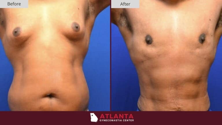 Atlanta Gynecomastia Center Before After 10A