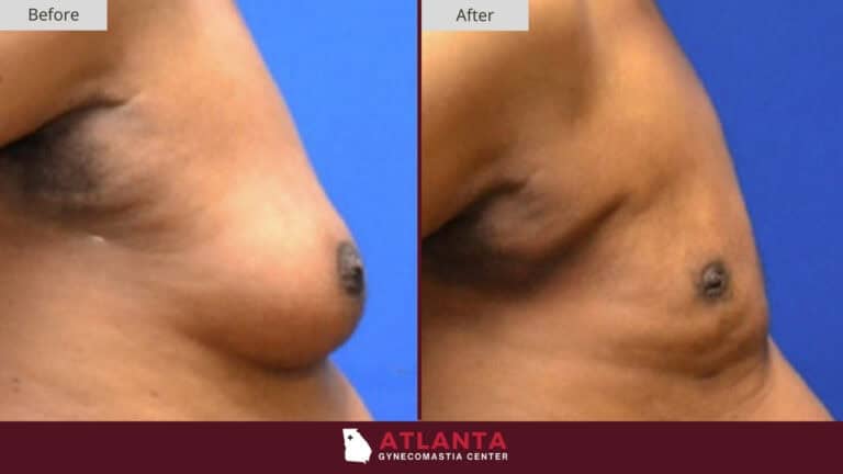 Atlanta Gynecomastia Center Before After 10B