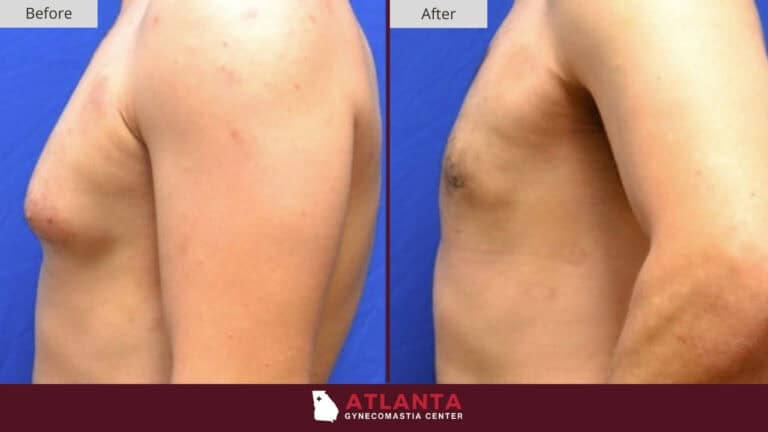 Atlanta Gynecomastia Center Before After 11A
