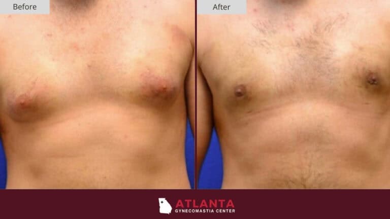 Atlanta Gynecomastia Center Before After 11B