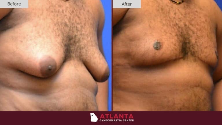 Atlanta Gynecomastia Center Before After 15A