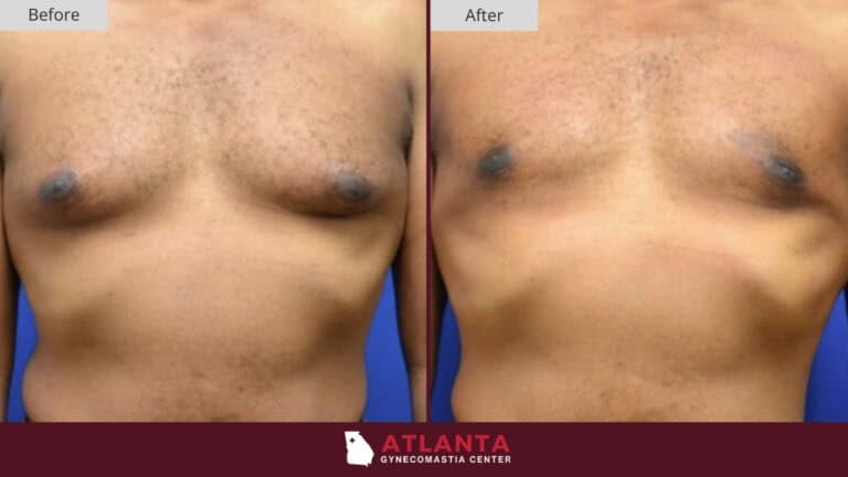 Atlanta Gynecomastia Center Before After 1A