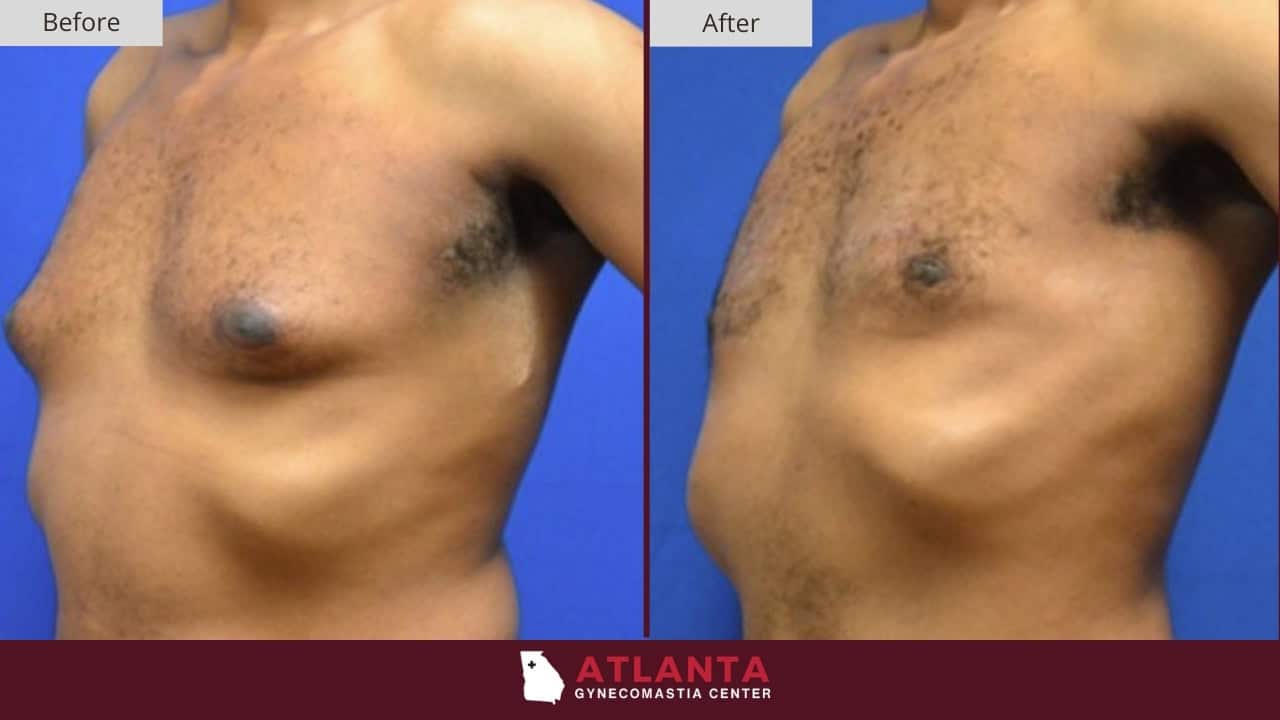Atlanta Gynecomastia Center Before After 1B