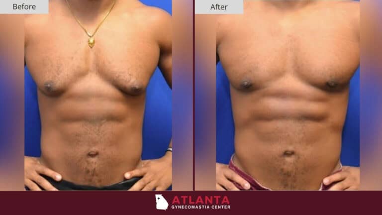 Atlanta Gynecomastia Center Before After 2A