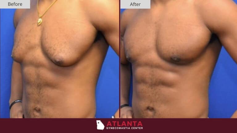 Atlanta Gynecomastia Center Before After 2B