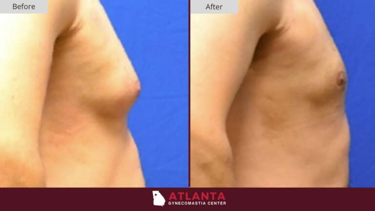 Atlanta Gynecomastia Center Before After 4A