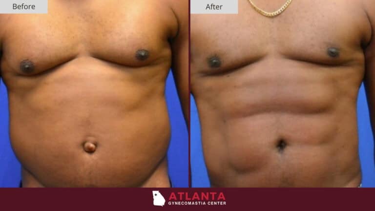 Atlanta Gynecomastia Center Before After 50b