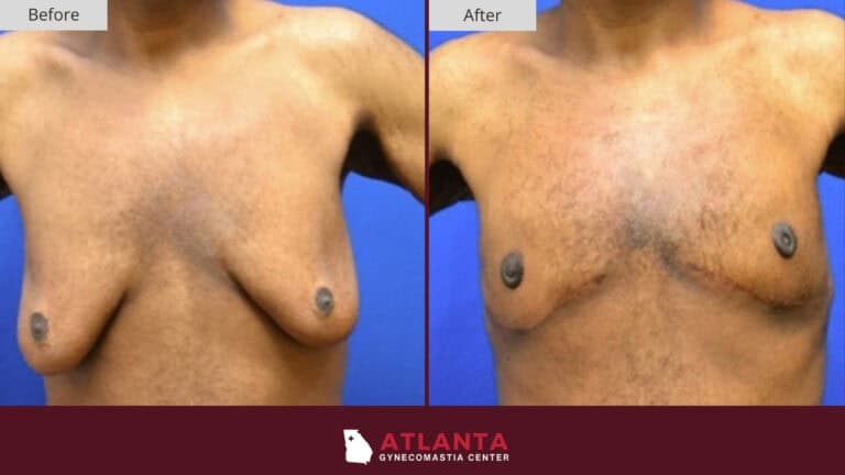 Atlanta Gynecomastia Center Before After 52B