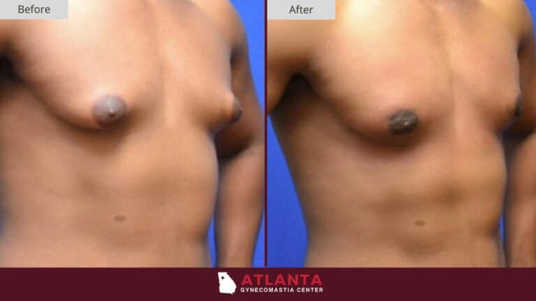 Atlanta Gynecomastia Center Before After 7A