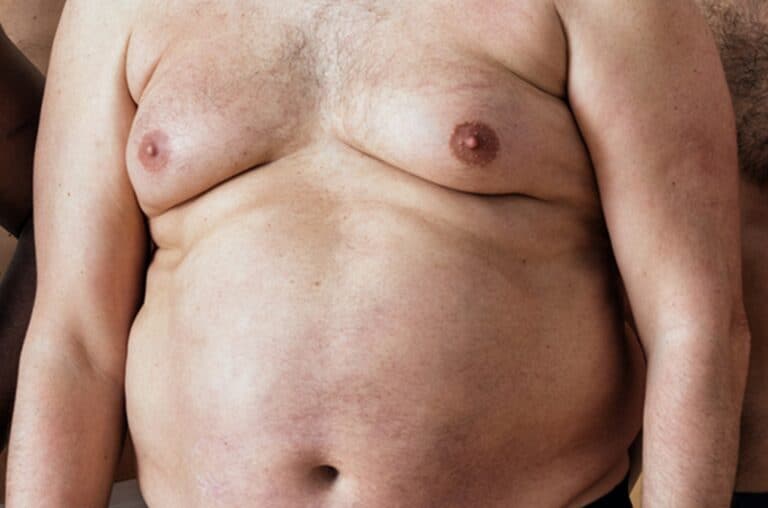 fat man with severe gynecomastia